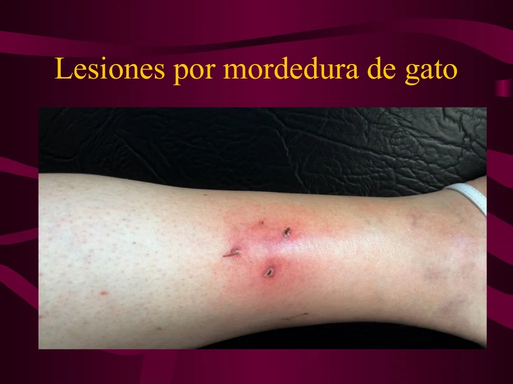 Celulitis por mordedura de gato