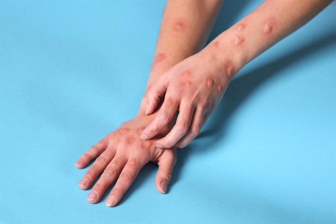 la oms mantiene como alto el riesgo para la salud publica de la nueva variante de mpox