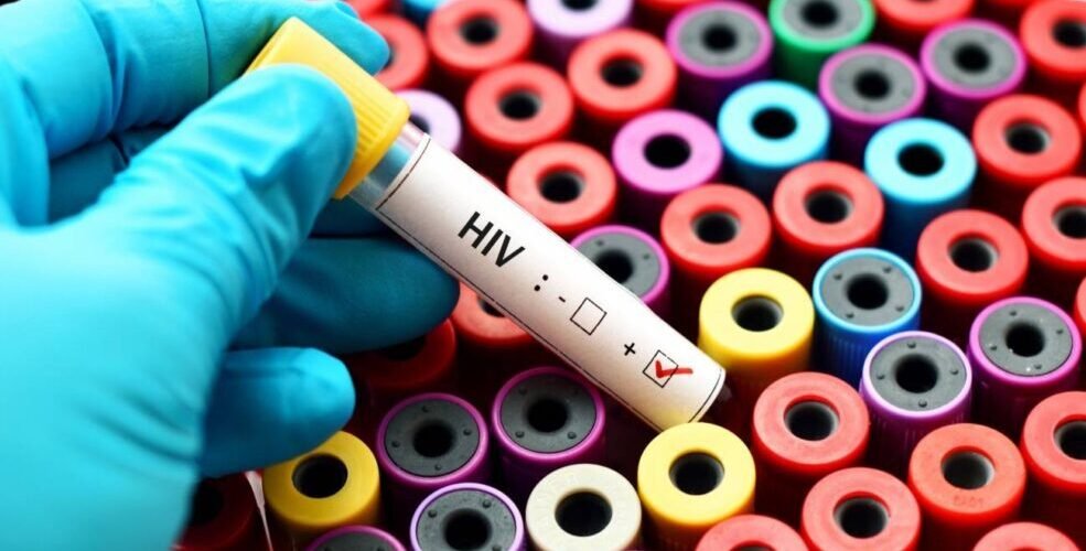 persisten los diagnosticos tardios de vih en espana pese al descenso de nuevos casos