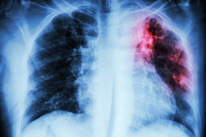 la covid 19 grave y la fibrosis pulmonar comparten mecanismos biologicos