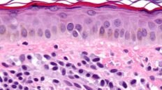 el sistema inmunitario es clave en el desarrollo de la mastocitosis