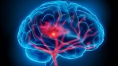 consejos de los fisioterapeutas para prevenir el ictus