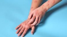 espana registro 633 casos de mpox durante el ano 2024 ninguno de la nueva variante