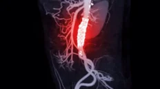 la inhibicion de la enzima acly la tecnica que podria frenar el empeoramiento del aneurisma de aorta abdominal