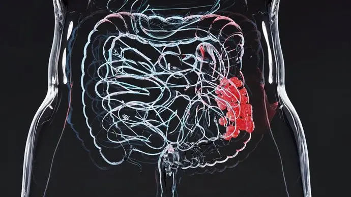 cancer colorrectal metastasico como los inhibidores de inmunoterapia mejoran la supervivencia