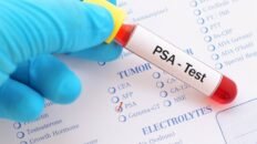 los hombres que rechazan las pruebas de cancer de prostata tienen mayor mortalidad