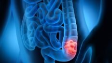 la mortalidad por cancer colorrectal se redujo un 20 en las ultimas dos decadas