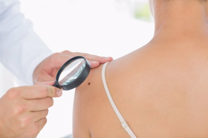 descubren como el melanoma y otros tumores se ocultan para eludir la inmunoterapia