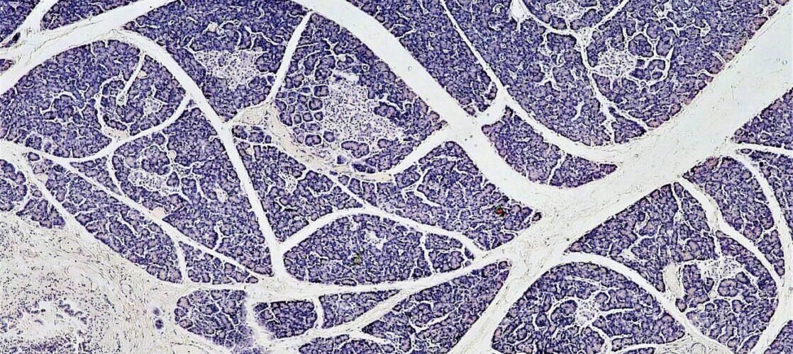 mas cerca del objetivo de tratar la diabetes tipo 1 con trasplantes de islotes pancreaticos