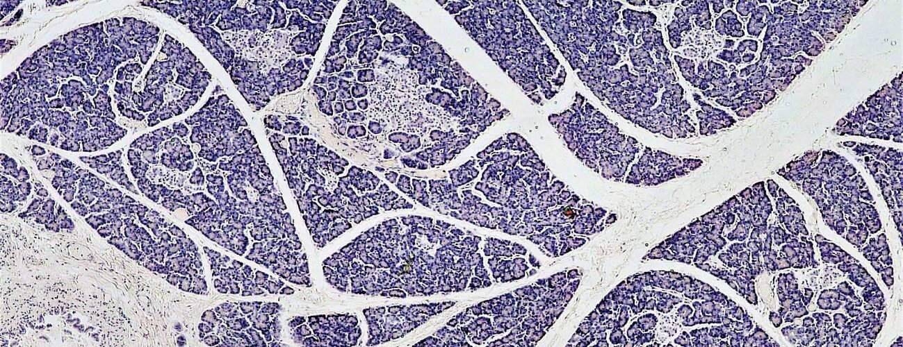 mas cerca del objetivo de tratar la diabetes tipo 1 con trasplantes de islotes pancreaticos
