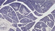 mas cerca del objetivo de tratar la diabetes tipo 1 con trasplantes de islotes pancreaticos