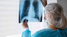 identifican una nueva diana terapeutica para el cancer de pulmon