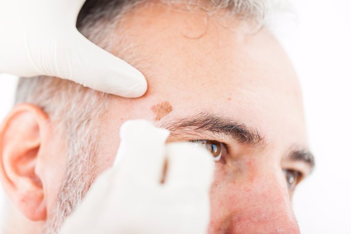 melanoma y parkinson dos enfermedades una proteina en comun