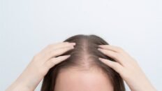 alopecia androgenica femenina causas sintomas y tratamientos mas efectivos