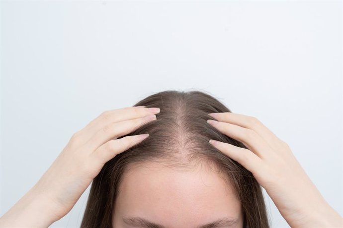 alopecia androgenica femenina causas sintomas y tratamientos mas efectivos