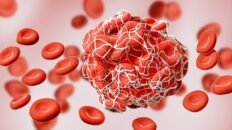 microplasticos en las arterias del cuello a quienes afectan mas y que riesgos implica