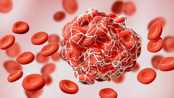 microplasticos en las arterias del cuello a quienes afectan mas y que riesgos implica