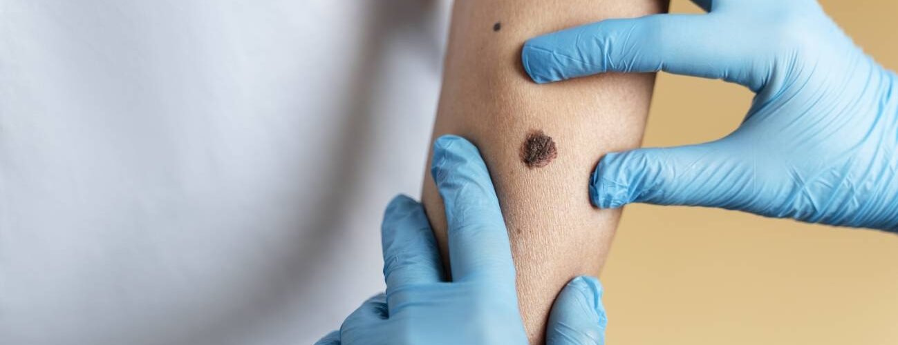 inmunoterapia el tratamiento clave contra los melanomas