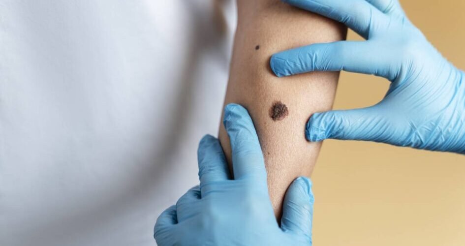 inmunoterapia el tratamiento clave contra los melanomas