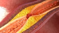 descubren como la respuesta inmunitaria controla la aterosclerosis que provoca infartos e ictus