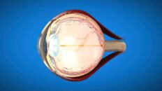 crean microesferas cargadas de farmacos para tratar el glaucoma de forma integral