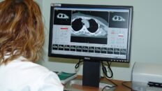 la ia mejora la prediccion de recaidas en pacientes con cancer
