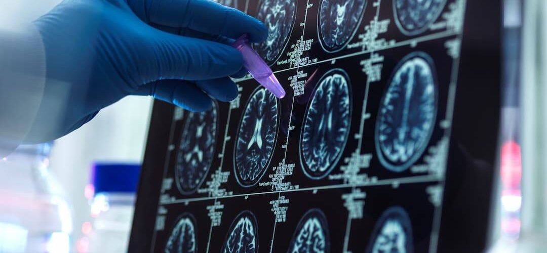 crean la escala de riesgo genetico de alzheimer mas completa hasta la fecha