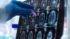 crean la escala de riesgo genetico de alzheimer mas completa hasta la fecha