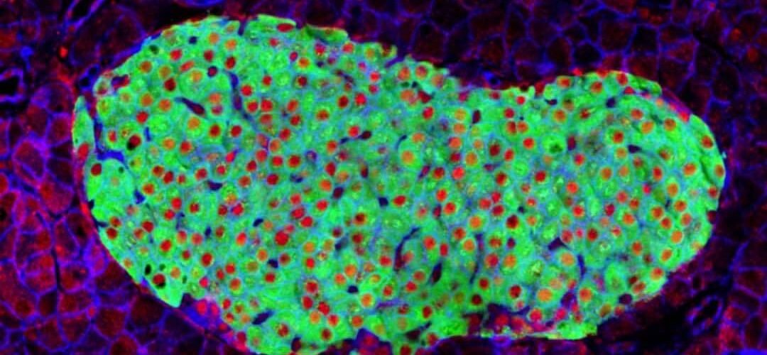 describen el mecanismo detras de un gen mutado que predispone a la diabetes tipo 2