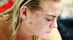 la adolescencia temprana es clave para introducir probioticos que podrian prevenir el acne