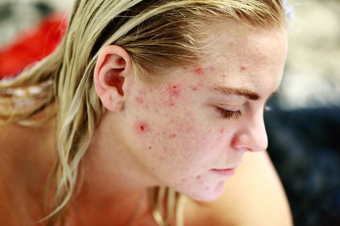 la adolescencia temprana es clave para introducir probioticos que podrian prevenir el acne
