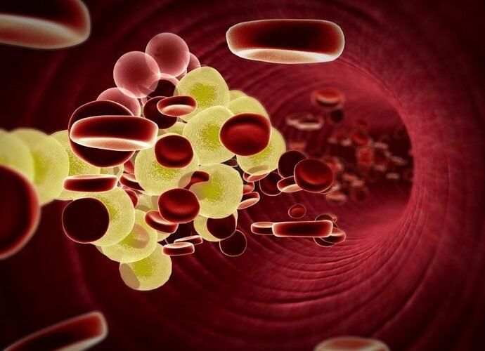 trigliceridos altos el enemigo silencioso en tu sangre que puede causar aneurismas aorticos