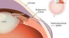 desarrollan un microstent con una forma unica para combatir el glaucoma