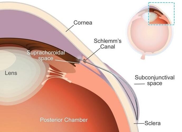 desarrollan un microstent con una forma unica para combatir el glaucoma