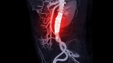 identifican un nuevo mecanismo que causa aneurismas de aorta y una posible forma de prevencion