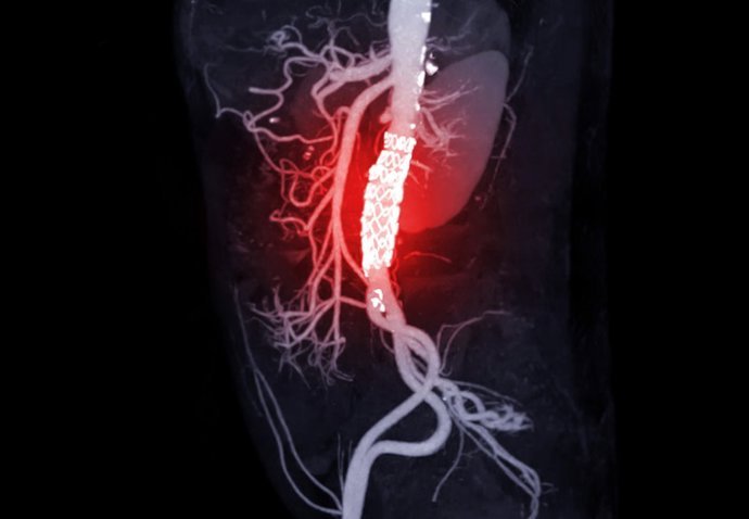 identifican un nuevo mecanismo que causa aneurismas de aorta y una posible forma de prevencion