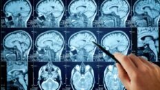 identifican por primera vez las senales cerebrales del olvido de recuerdos desagradables