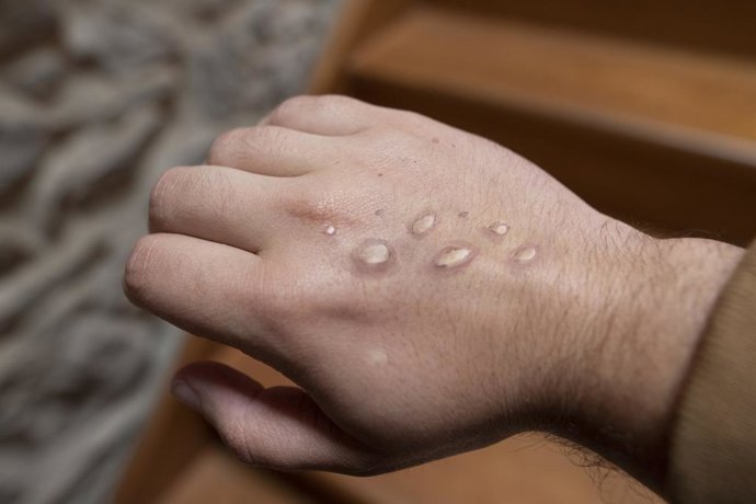 la oms informa de que el 90 de los nuevos casos notificados de mpox se concentran en africa